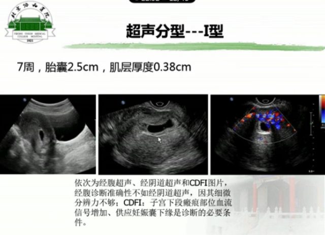超声分型1.png