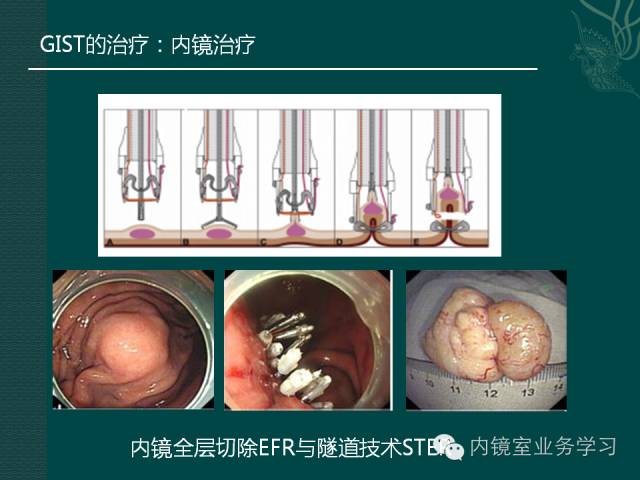 什么是间质瘤