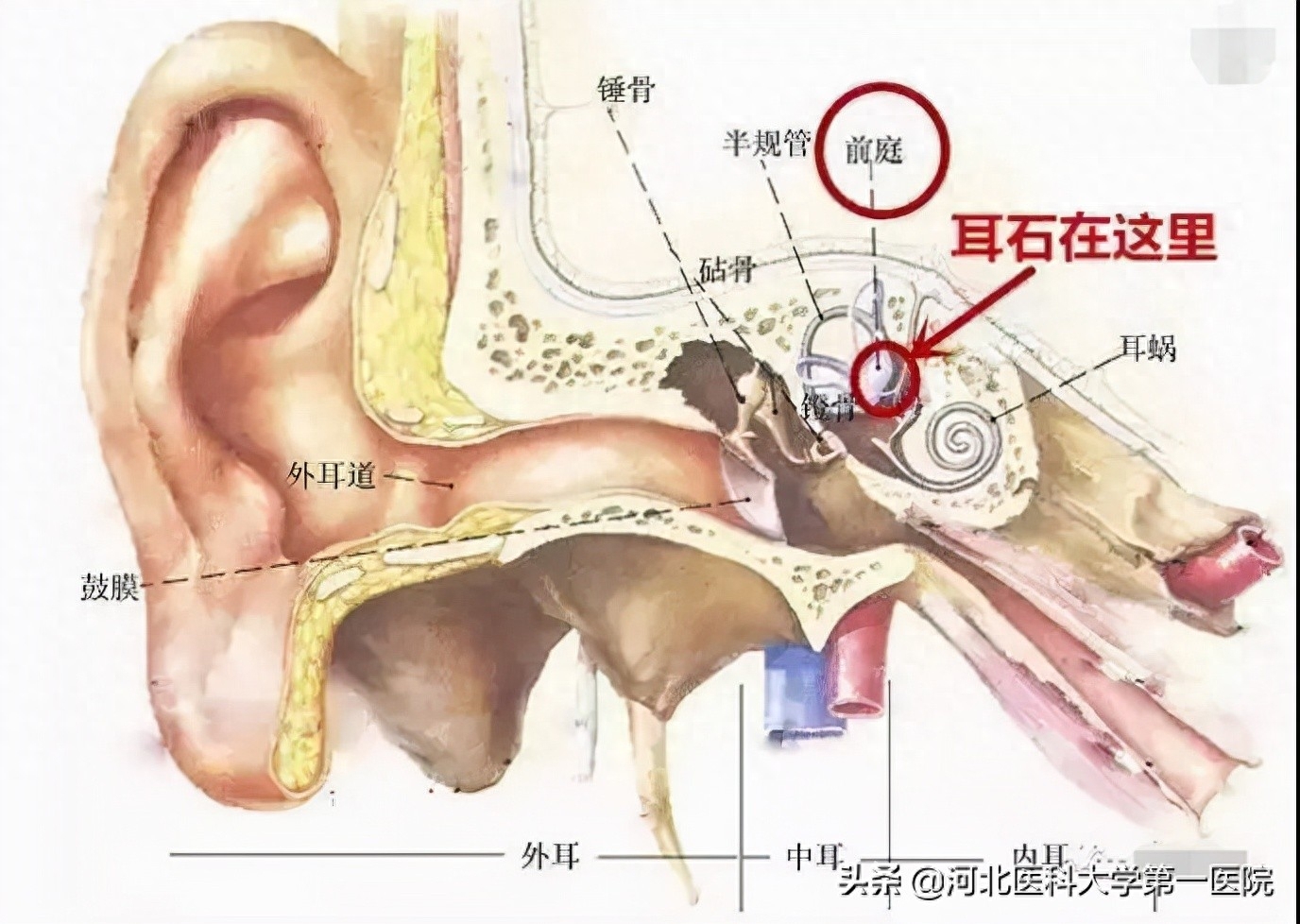 梅尼埃病算大病吗