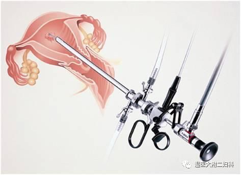 宫腔镜手术可以报销吗